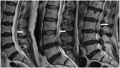 MRI parameters predict central lumbar spinal stenosis combined with redundant nerve roots: a prospective MRI study